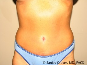 Tummy Tuck Before and After | Sanjay Grover MD FACS