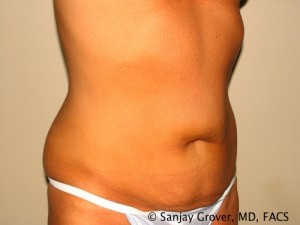 Tummy Tuck Before and After 48 | Sanjay Grover MD FACS