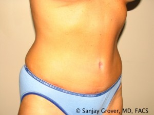 Tummy Tuck Before and After 48 | Sanjay Grover MD FACS