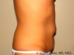 Tummy Tuck Before and After 48 | Sanjay Grover MD FACS