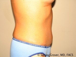 Tummy Tuck Before and After 48 | Sanjay Grover MD FACS