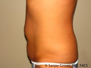 Tummy Tuck Before and After 48 | Sanjay Grover MD FACS