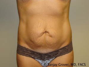 Tummy Tuck Before and After | Grover Aesthetics