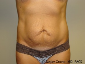 Tummy Tuck Before and After 09 | Sanjay Grover MD FACS