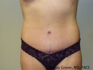 Tummy Tuck Before and After | Grover Aesthetics