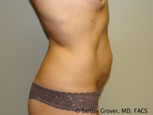 Tummy Tuck Before and After 49 | Sanjay Grover MD FACS