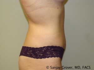 Tummy Tuck Before and After 49 | Sanjay Grover MD FACS