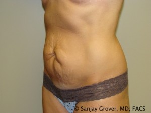 Tummy Tuck Before and After 49 | Grover Aesthetics