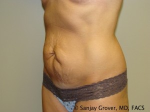 Tummy Tuck Before and After 49 | Sanjay Grover MD FACS