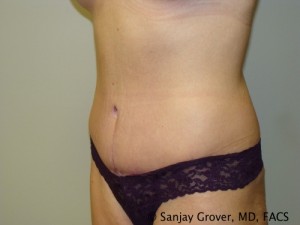 Tummy Tuck Before and After 49 | Sanjay Grover MD FACS