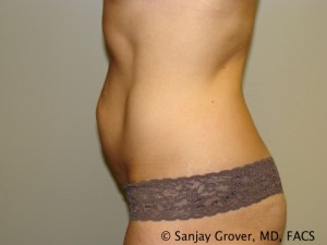 Tummy Tuck Before and After 49 | Sanjay Grover MD FACS