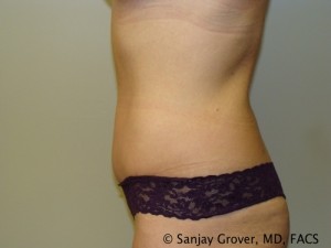 Tummy Tuck Before and After 49 | Sanjay Grover MD FACS