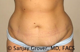 Tummy Tuck Before and After 40 | Sanjay Grover MD FACS