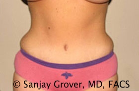 Tummy Tuck Before and After 50 | Sanjay Grover MD FACS