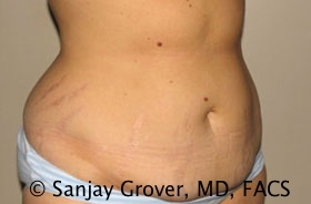 Tummy Tuck Before and After 50 | Grover Aesthetics