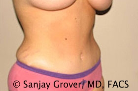 Tummy Tuck Before and After 50 | Grover Aesthetics