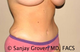 Tummy Tuck Before and After 50 | Sanjay Grover MD FACS