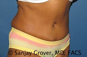 Tummy Tuck Before and After 50 | Sanjay Grover MD FACS