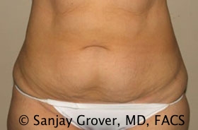 Tummy Tuck Before and After 16 | Sanjay Grover MD FACS