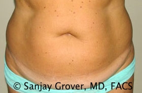 Tummy Tuck Before and After | Grover Aesthetics