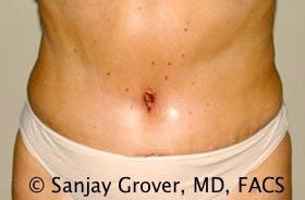 Tummy Tuck Before and After 51 | Sanjay Grover MD FACS