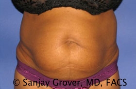 Tummy Tuck Before and After | Grover Aesthetics