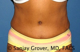 Tummy Tuck Before and After 52 | Sanjay Grover MD FACS