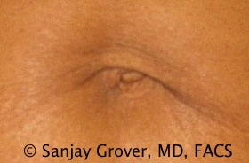 Tummy Tuck Before and After 52 | Grover Aesthetics
