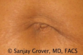 Tummy Tuck Before and After 52 | Sanjay Grover MD FACS