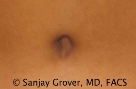 Tummy Tuck Before and After 52 | Sanjay Grover MD FACS