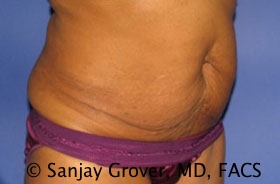 Tummy Tuck Before and After 52 | Grover Aesthetics