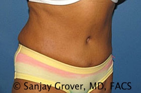 Tummy Tuck Before and After 52 | Grover Aesthetics
