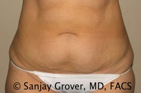 Tummy Tuck Before and After | Grover Aesthetics