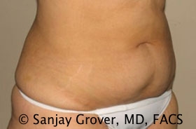 Tummy Tuck Before and After 53 | Grover Aesthetics