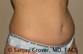 Tummy Tuck Before and After 53 | Grover Aesthetics