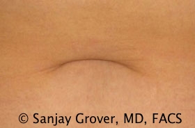 Tummy Tuck Before and After 53 | Grover Aesthetics