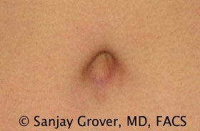 Tummy Tuck Before and After 53 | Grover Aesthetics