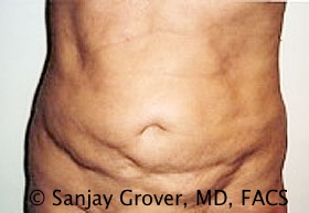 Tummy Tuck Before and After 77 | Sanjay Grover MD FACS