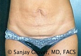 Tummy Tuck Before and After | Grover Aesthetics