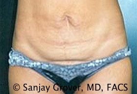 Tummy Tuck Before and After 90 | Sanjay Grover MD FACS