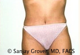 Tummy Tuck Before and After | Grover Aesthetics