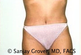 Tummy Tuck Before and After | Sanjay Grover MD FACS