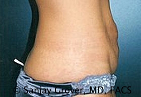 Tummy Tuck Before and After 54 | Sanjay Grover MD FACS