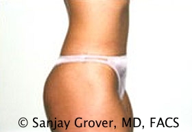 Tummy Tuck Before and After 54 | Sanjay Grover MD FACS