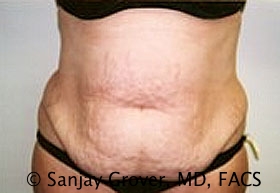 Tummy Tuck Before and After 07 | Sanjay Grover MD FACS