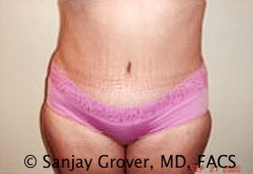 Tummy Tuck Before and After | Grover Aesthetics