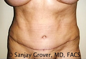 Tummy Tuck Before and After | Grover Aesthetics