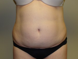 Tummy Tuck Before and After | Grover Aesthetics