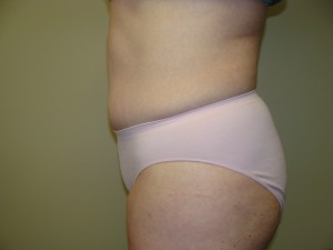 Tummy Tuck Before and After 57 | Sanjay Grover MD FACS