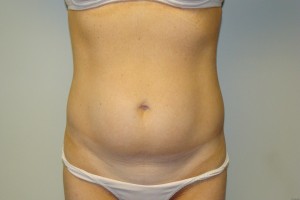 Tummy Tuck Before and After 59 | Sanjay Grover MD FACS